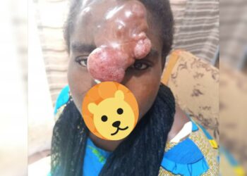 Abu Jinapor supports Surgery of a spindle cell Sarcoma patient with over Ghc15,000