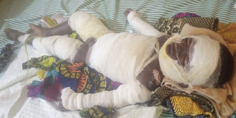 Fire Accident Leaves Two Siblings Critically Injured in Damongo